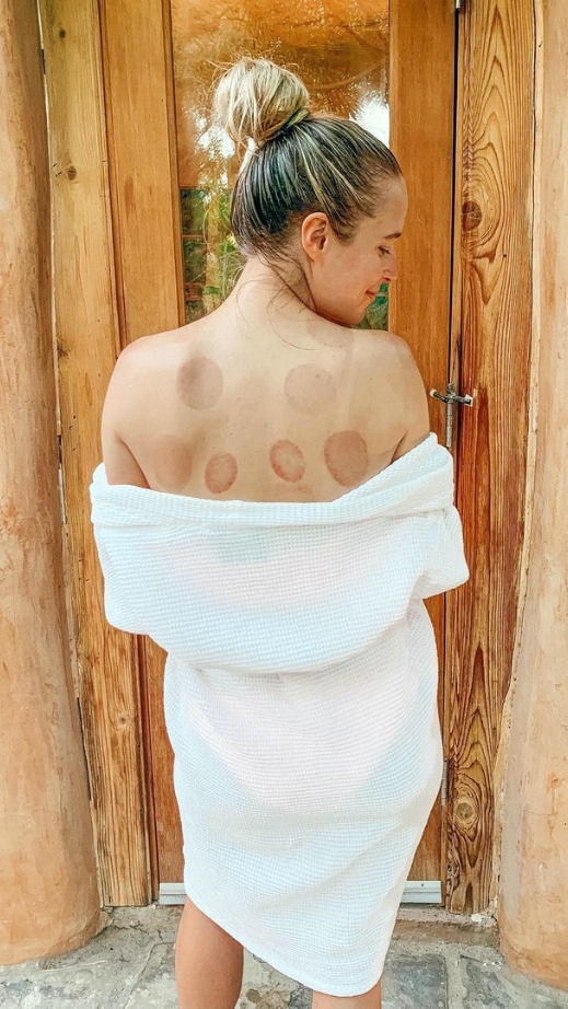 A woman wrapped in a towel at a luxury health spa, showcasing a brown spot on her back.
