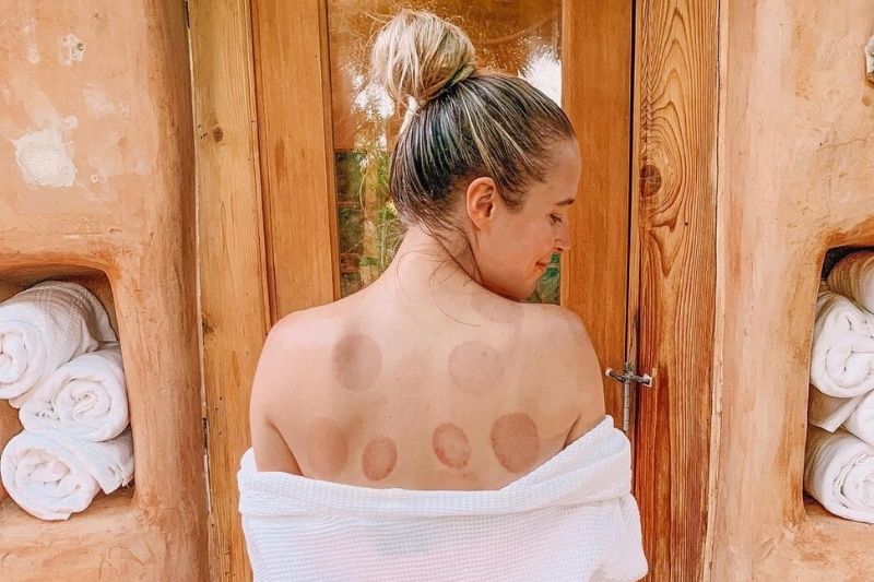 A wellness guest experiences restorative cupping therapy to support relaxation and holistic body recovery.