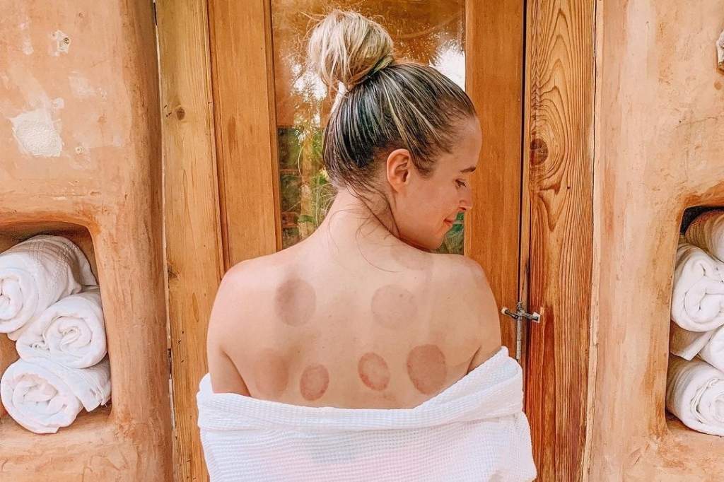 Guest enjoying a therapeutic cupping session at a California fasting retreat spa